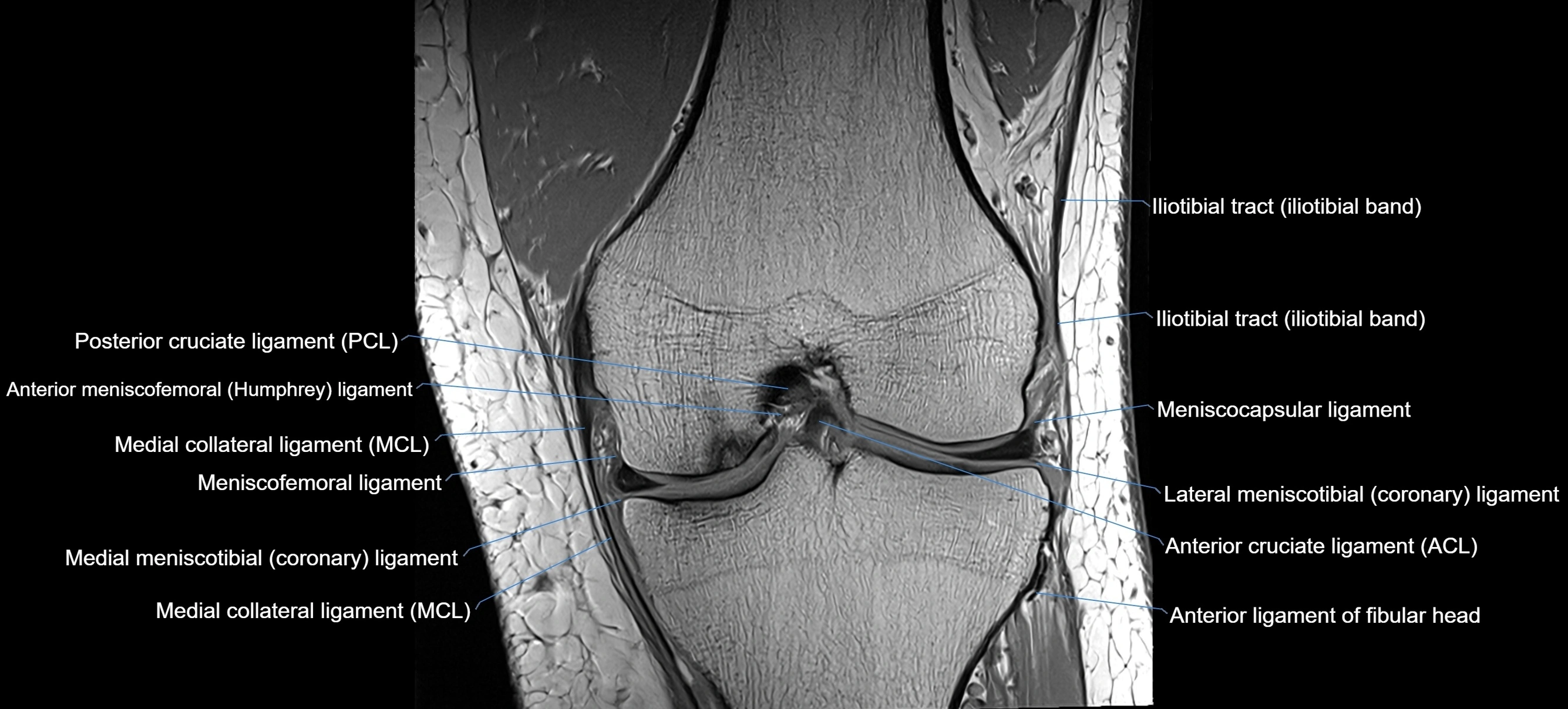 MRI coronal  ligaments cross sectional anatomy 3T  radiology  image-img-04001-00020.webp